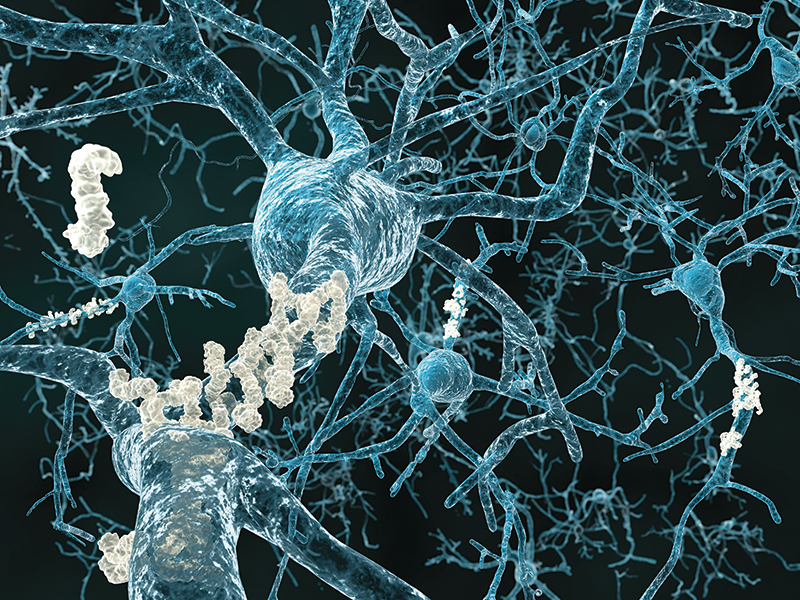 The brains of Alzheimer’s patients often reveal two phenomena: plaques and tangles. Here amyloid plaques attach to neurons within the brain.